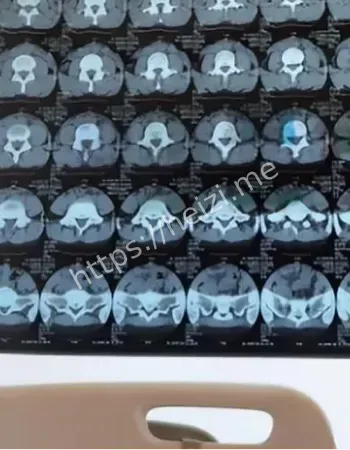 腰椎骨折