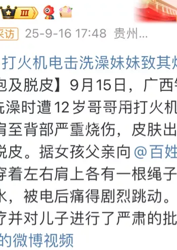 儿童烧烫伤