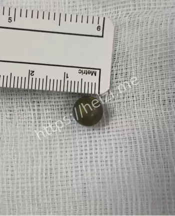 坤塔帕花儿童医院手术成功