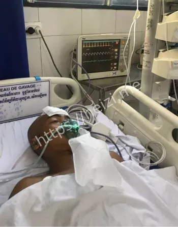 儿童头部气枪子弹取出