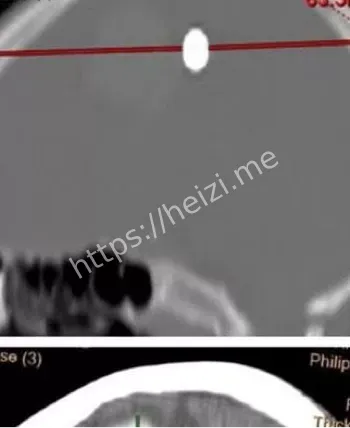 金边脑损伤医疗奇迹